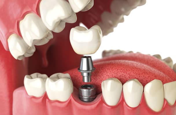 why might dental implants be needed new