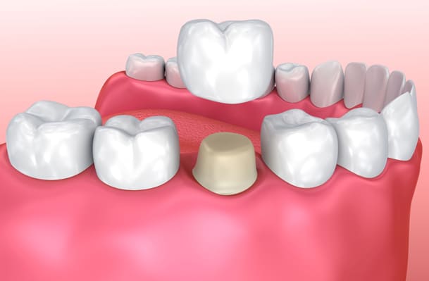 why would dental crowns be needed new