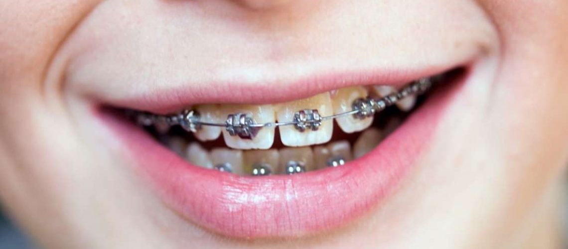 Does It Hurt To Wear Braces