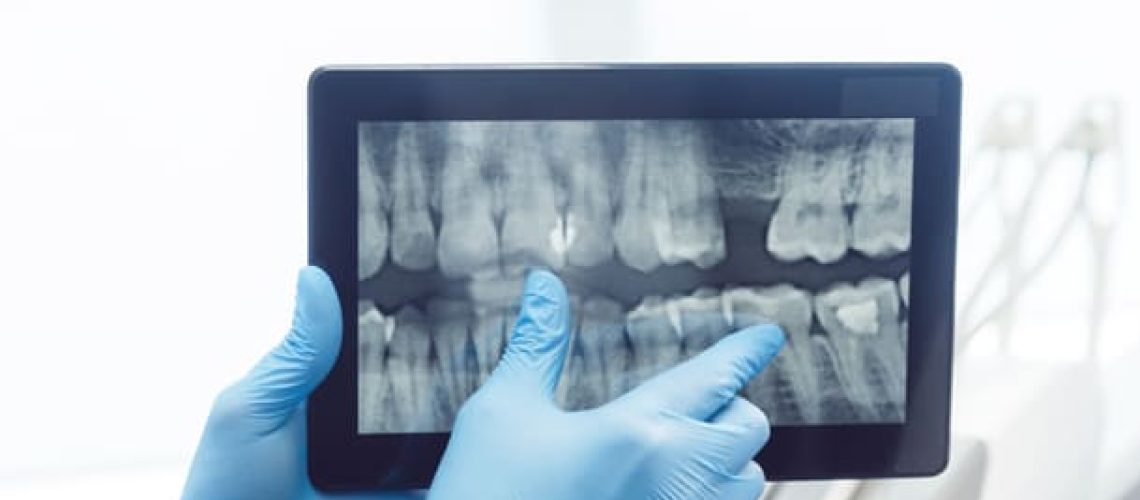 dental x rays